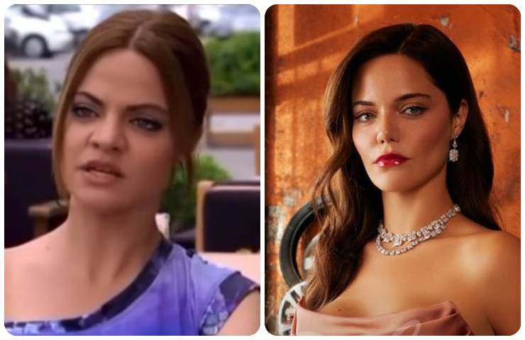 Hilal Altinbilek prima e dopo la chirurgia estetica